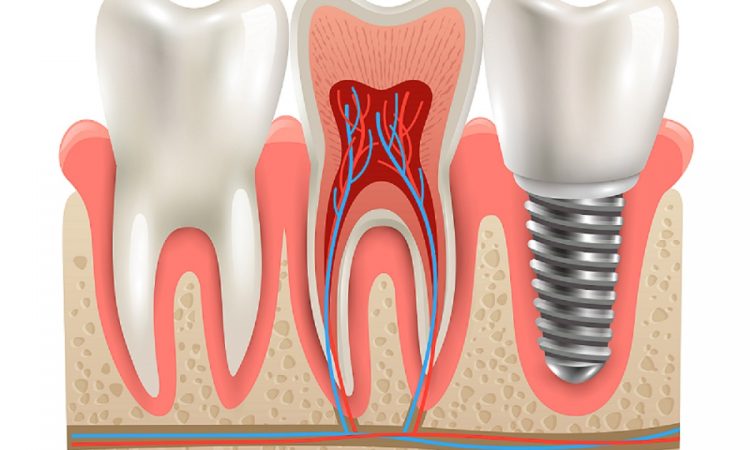 Impianti dentali: sciogliamo i dubbi più diffusi