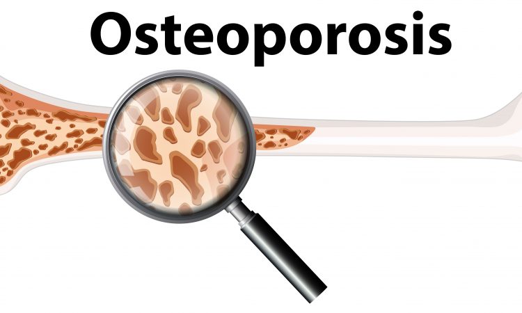 OSTEOPOROSI E DENTISTA