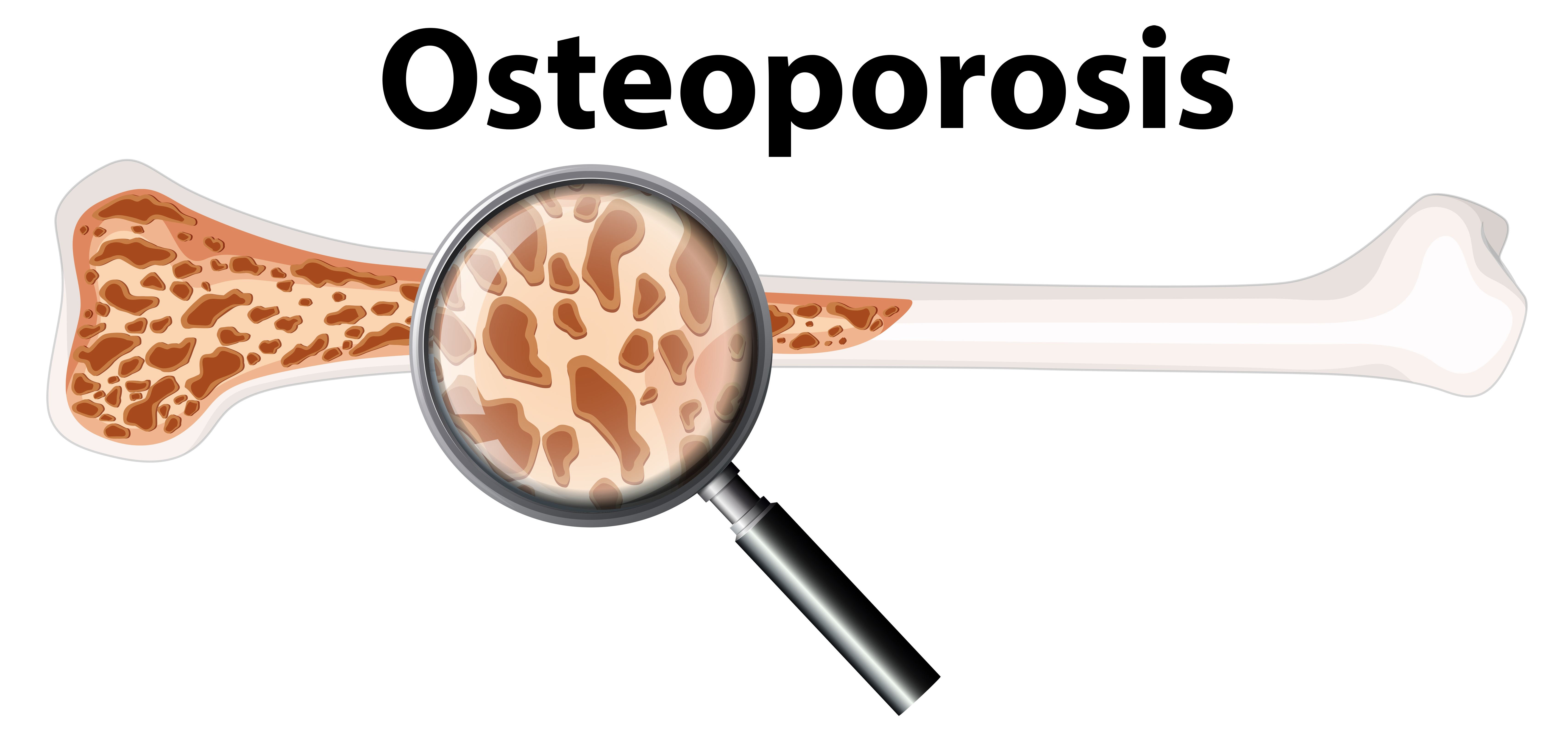 osteoporosi e dentista